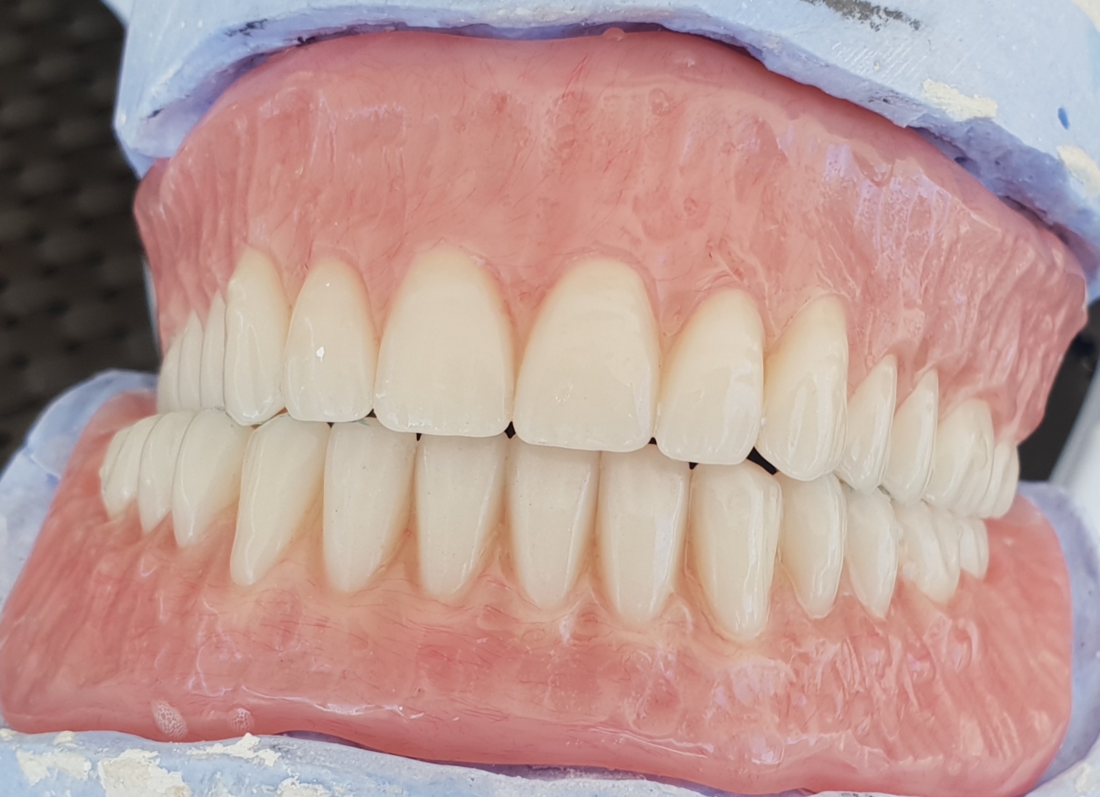 Custom dentures crafted at CAV Denture Clinic